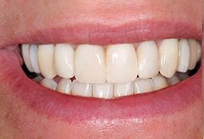 Benson Family Dentistry | Teeth Whitening, Dental Bridges and Paperless Charting